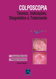 Continuar lendo: Colposcopia: Técnica, Indicações, Diagnóstico e Tratamento